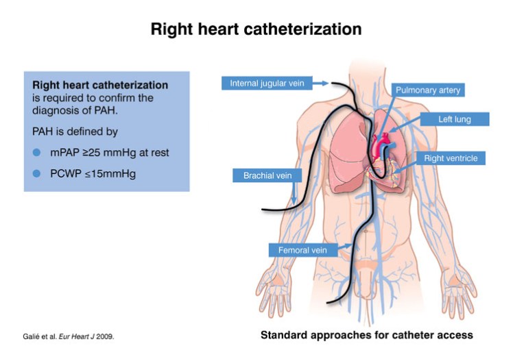 RHC diagram