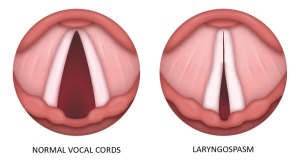parmley_laryngospasm